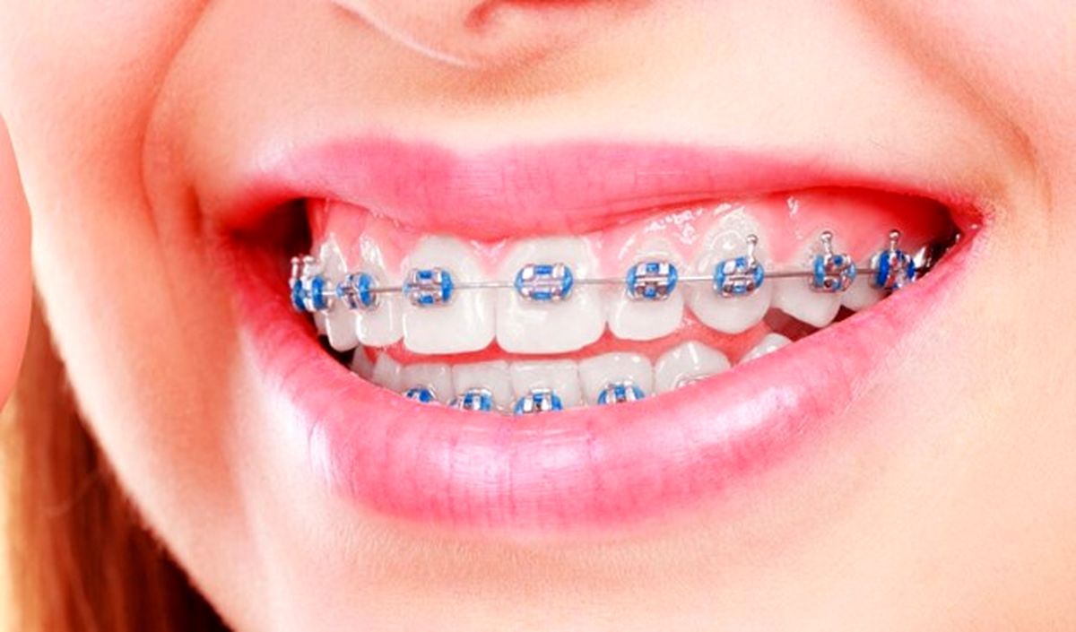 با انواع ارتودنسی دندان و مزایای آن آشنا شوید