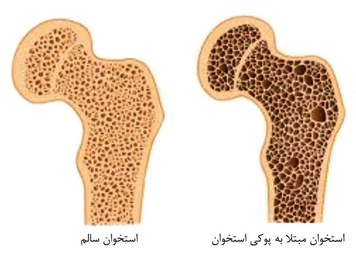این علائم یعنی استخوان های شما پوک می‌شود