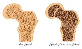 این علائم یعنی استخوان های شما پوک می‌شود