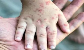 تست آنتی‌بادی ضد سرخک هیچ مبنای علمی ندارد