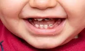 از پوسیدگی دندان شیرخواران خود جلوگیری کنید