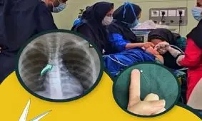 خارج کردن سوزن از مجرای تنفسی کودک ۹ ساله در بندرعباس

