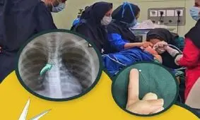 خارج کردن سوزن از مجرای تنفسی کودک ۹ ساله در بندرعباس

