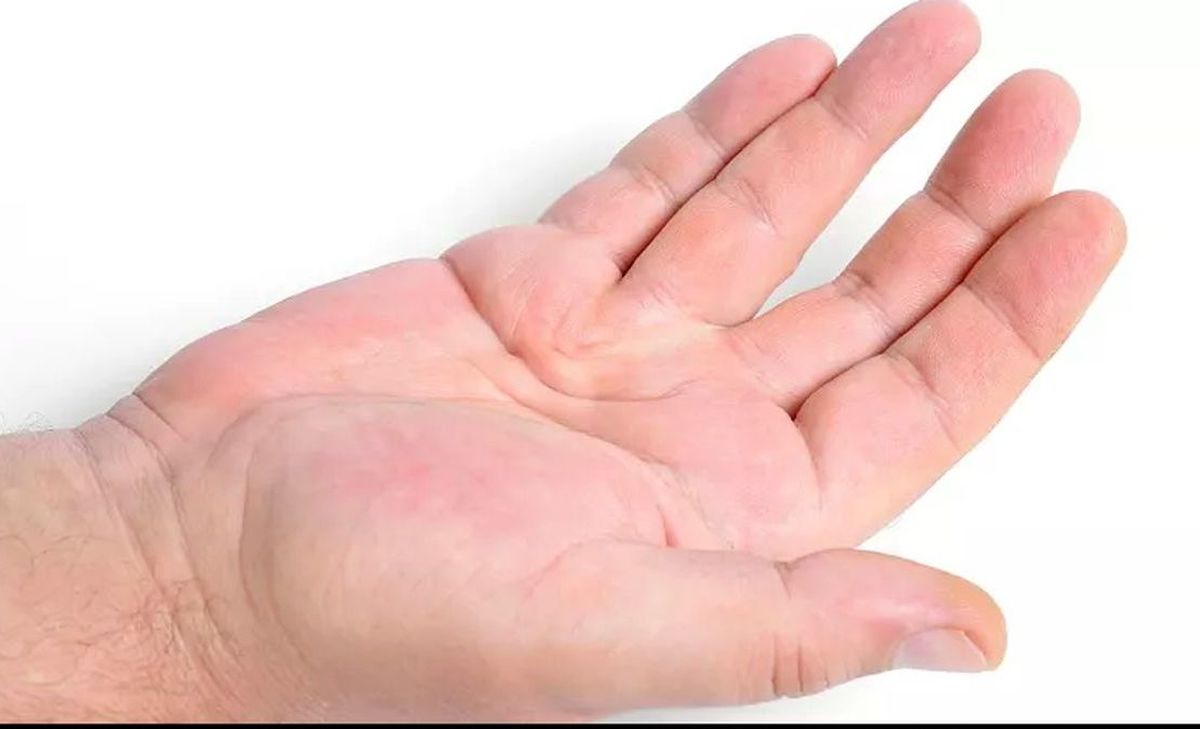 «بیماری وایکینگ» از نئاندرتالها به ما به ارث رسیده است