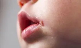 آفت و تبخال در کودکان چه تفاوتی دارد؟