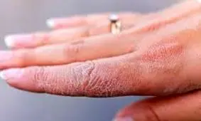 چند توصیه برای کاهش خشکی پوست