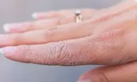 چند توصیه برای کاهش خشکی پوست