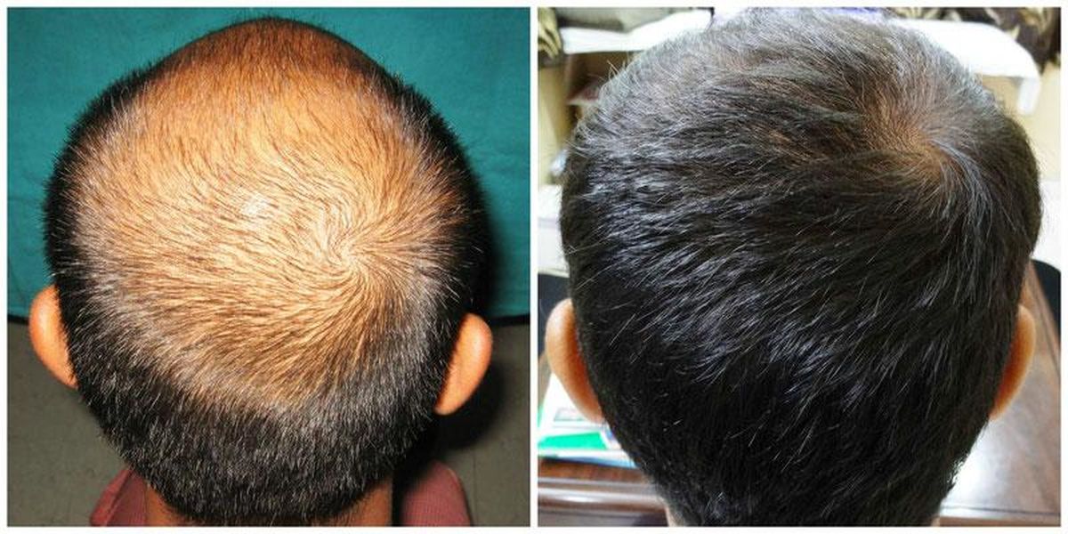 آیا فرد دیابتی میتواند کاشت مو انجام دهد؟