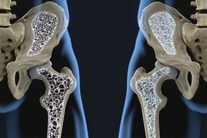 استخوان های ضعیف احتمال خطر ابتلا به این بیماری را افزایش می‌دهد