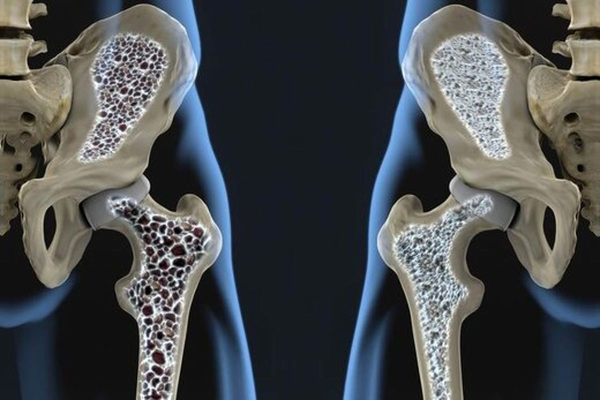 استخوان های ضعیف احتمال خطر ابتلا به این بیماری را افزایش می‌دهد