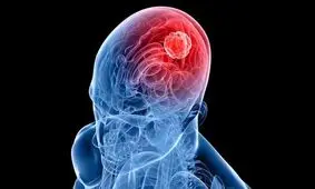 رژیم غذایی ویژه ای که خودکشی سلول های سرطان مغز را تحریک می کند

