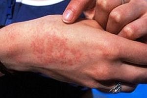 ابتلای بیش از ۱۹ هزار نفر به تب مالت در ایران
