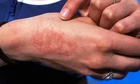 ابتلای بیش از ۱۹ هزار نفر به تب مالت در ایران