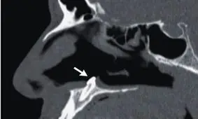 مردی که تنگی نفس داشت بخاطر رویش یک دندان در بینی جراحی شد