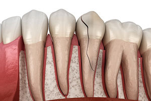 چه چیزی باعث ایجاد شقاق دندان می شود؟