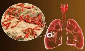 ابتلای ۶ هزار ایرانی به یک بیماری خطرناک ریوی/ ۸ استان در صدر شیوع بیماری