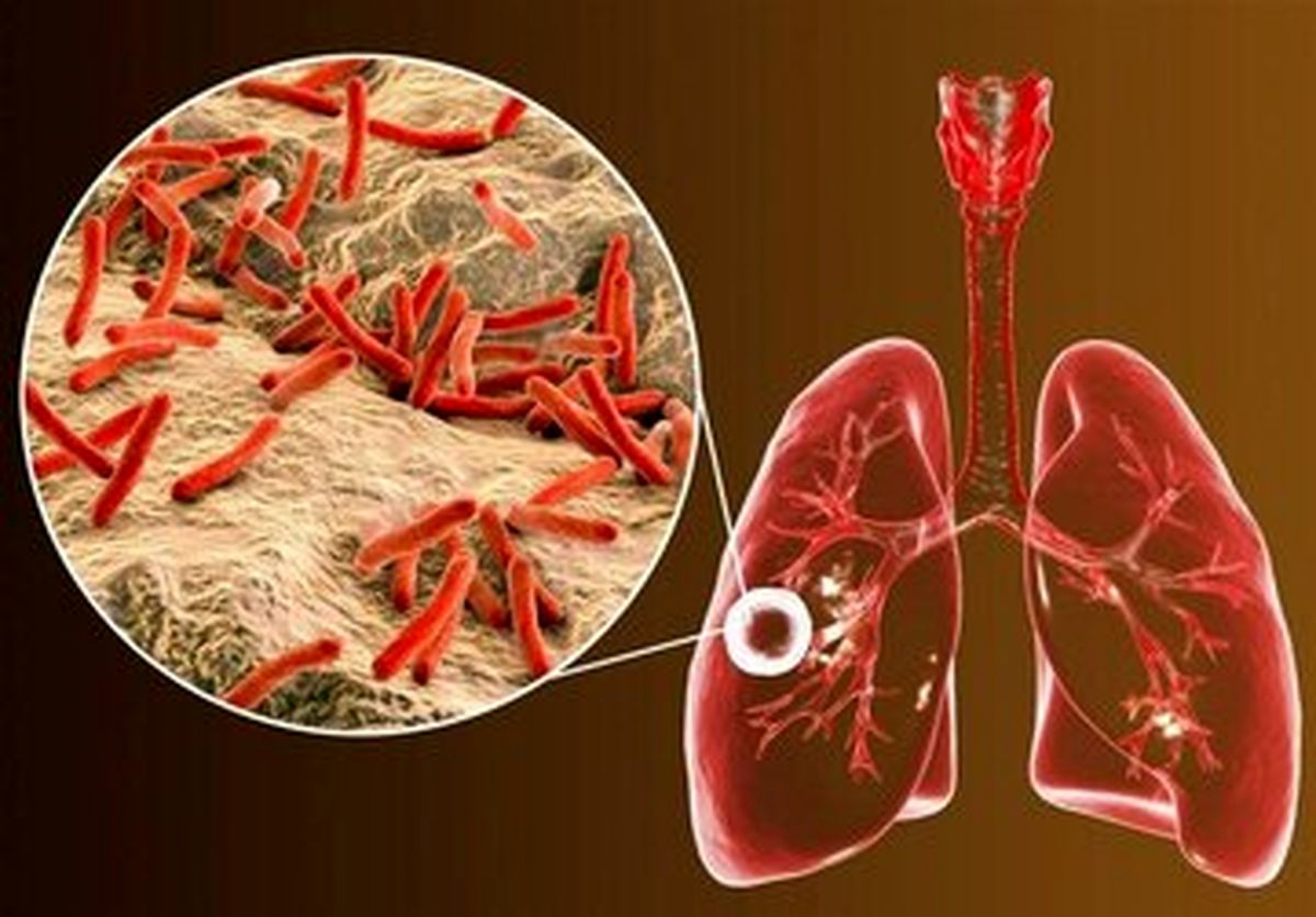 ابتلای ۶ هزار ایرانی به یک بیماری خطرناک ریوی/ ۸ استان در صدر شیوع بیماری