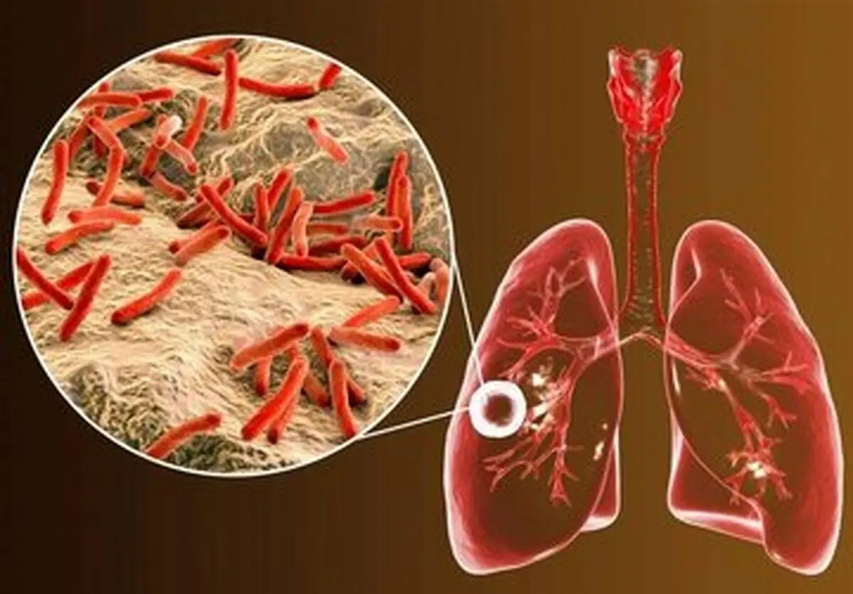 ابتلای ۶ هزار ایرانی به یک بیماری خطرناک ریوی/ ۸ استان در صدر شیوع بیماری