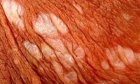 لیکن اسکلروز؛ اختلال التهابی پوست اندام تناسلی/ علائم و نشانه ها