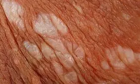 لیکن اسکلروز؛ اختلال التهابی پوست اندام تناسلی/ علائم و نشانه ها
