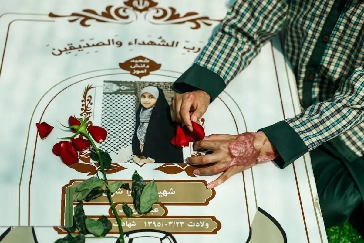 آثار بمباران آمریکایی بر دست دانش آموز میناب/ تصاویر