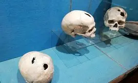 مته‌کاری؛ یک راهکار هولناک باستانی برای درمان مغز و اعصاب