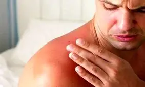 هشدار؛ مراقب سوختگی های پنهان آفتاب باشید