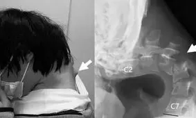 بیماری سندرم سر افتاده چه علائمی دارد؟/ عکس