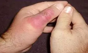 ایران در رتبه سوم عقرب‌زدگی در جهان

