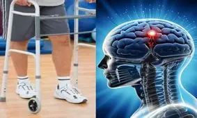 2 فرد مبتلا به آسیب نخاعی پس از کاشت الکترود در مغزشان، مسافت کوتاهی راه رفتند