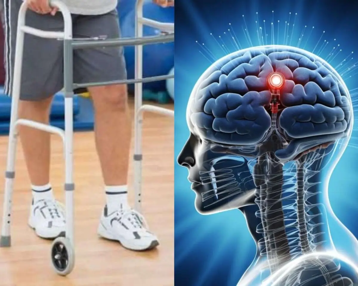 2 فرد مبتلا به آسیب نخاعی پس از کاشت الکترود در مغزشان، مسافت کوتاهی راه رفتند