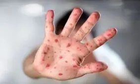 شیوع سرخک منجر به مسمومیت خطرناک ویتامین A می‌شود