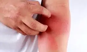 ارتباط مصرف سدیم با یک بیماری پوستی مزمن