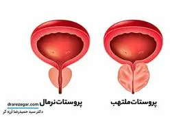 عادت های غلطی که باعث آسیب به پروستات می شوند