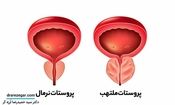 عادت های غلطی که باعث آسیب به پروستات می شوند