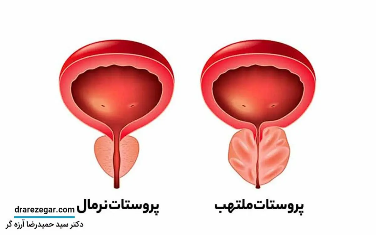 عادت های غلطی که باعث آسیب به پروستات می شوند