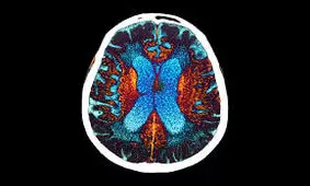 چربی مغز نقش مهمی در ایجاد آلزایمر دارد