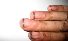 زیرِ ناخن‌های کثیف در دنیای میکروسکوپی چه خبر است؟/ ویدئو