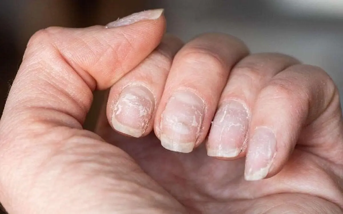 چطور از لایه لایه شدن ناخن پیشگیری کنیم؟