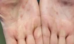 بهبودی بیمار مبتلا به آبله‌ میمونی در ایران/ شباهت علائم آبله میمونی و آبله مرغان