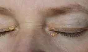 ۵ علامت پوستی که از عارضه قلبی خبر می‌دهند