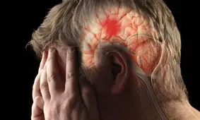 آمار عجیب سکته مغزی در ایران