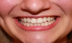 یک شرکت ژاپنی در مسیر تولید اولین دارو برای رویش دندان جدید