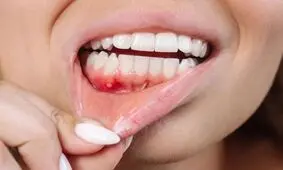مکمل‌های طبیعی؛ جایگزین آنتی‌بیوتیک در درمان بیماری شدید لثه

