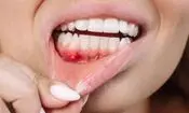 مکمل‌های طبیعی؛ جایگزین آنتی‌بیوتیک در درمان بیماری شدید لثه

