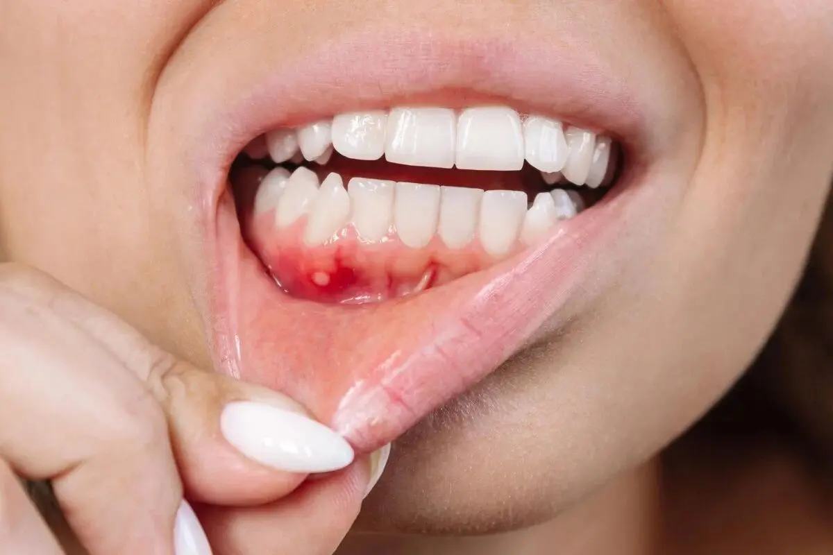 مکمل‌های طبیعی؛ جایگزین آنتی‌بیوتیک در درمان بیماری شدید لثه

