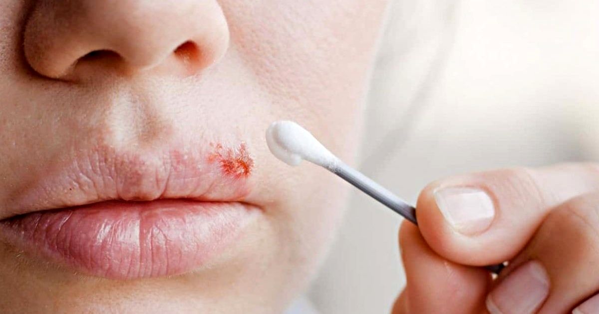 7 راه برای کاهش خطر انتشار ویروس تبخال