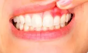 عفونت دندان و لثه چه بیماری‌هایی به دنبال دارد؟
