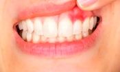 عفونت دندان و لثه چه بیماری‌هایی به دنبال دارد؟
