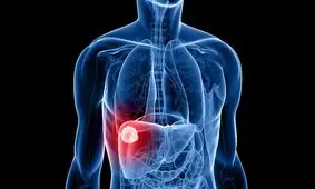 تشخیص سرطان کبد با آزمایش خون مبتنی بر هوش مصنوعی